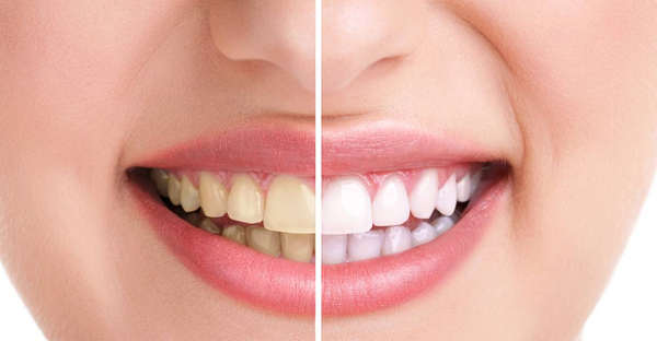 Obrázek zubů před a po bělení