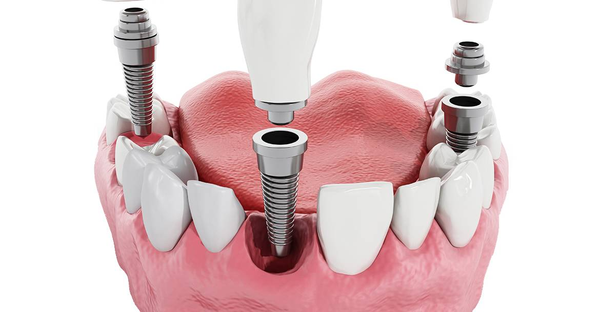 Model zubních implantátů