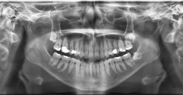 Rentgen zubů